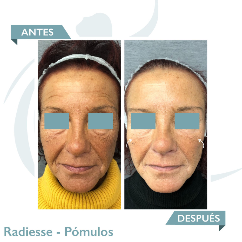 Radiesse - Hidroxiapatita Cálcica