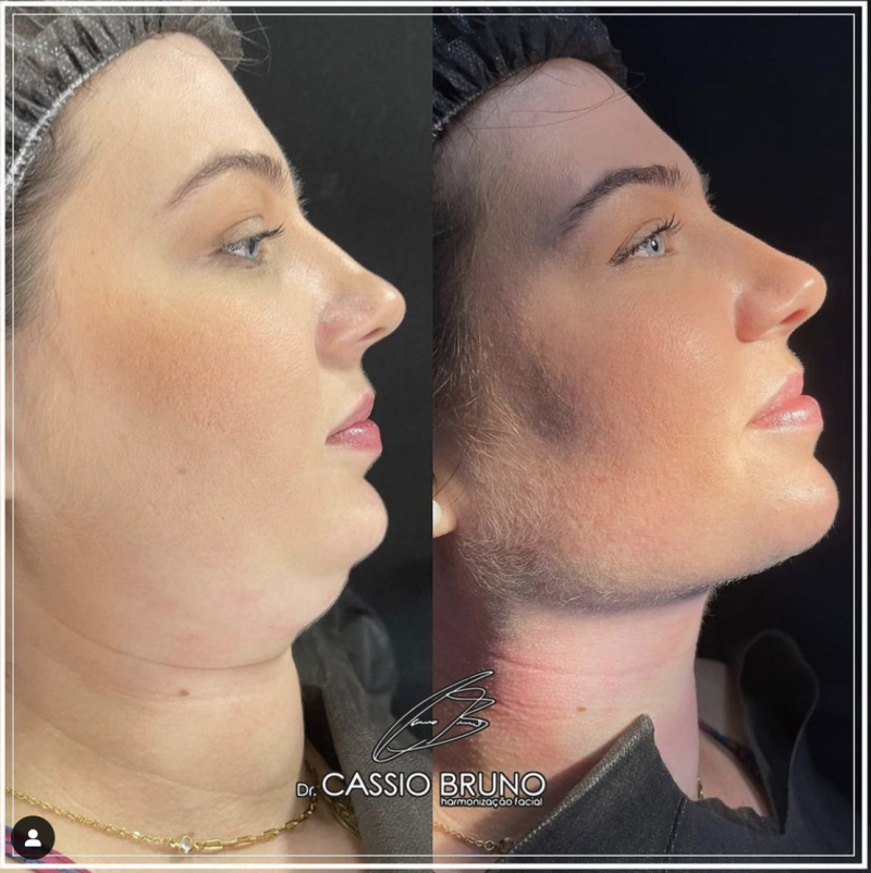 Master Class de Armonización Facial y Lipopapada HD con el Dr. Cassio Bruno