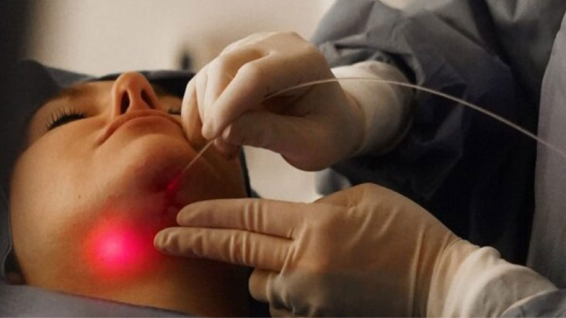 Tratamiento Endolift (Endoláser)